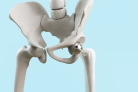 kalça protezi ameliyatı (2)