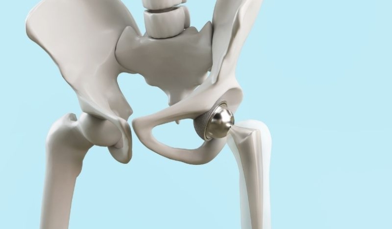 Ortopedik Cerrahi: Diz, Ön Çapraz Bağ ve Kalça Protezi Ameliyatları