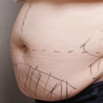 liposuction (3)