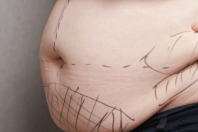 liposuction (3)