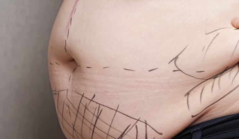 Estetik Ameliyatlar: Bişektomi, Karın Germe ve Liposuction