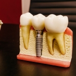 konya implant (3)