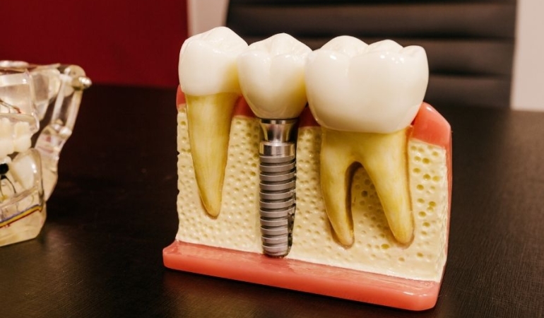 Konya’da Modern Diş Tedavilerinde Güvenilir Adres